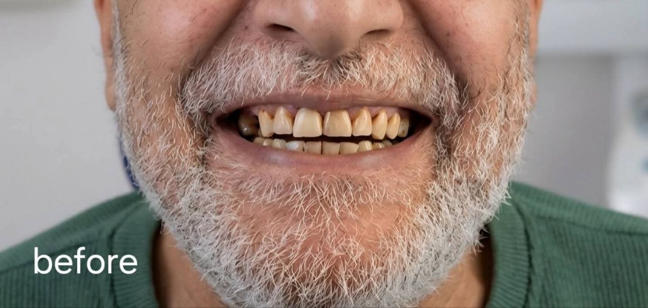 قبل التركيبات والفينيرز