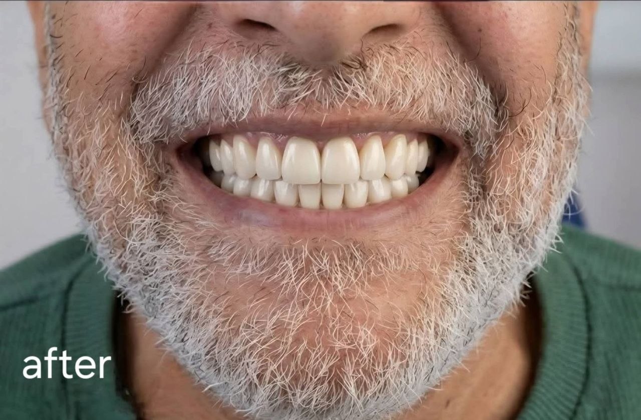 بعد التركيبات والفينيرز